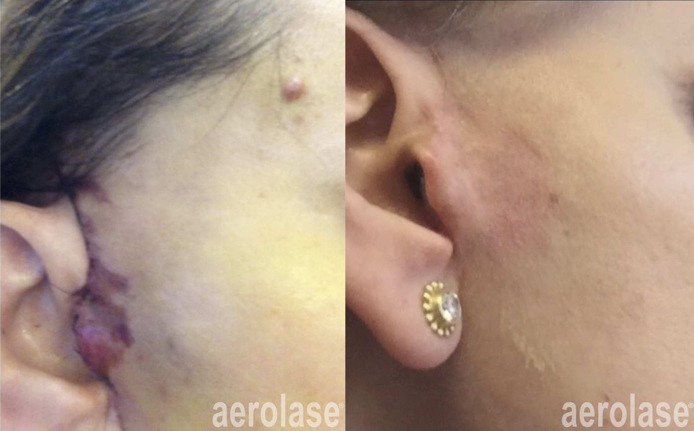 A post-surgical scar before and after with the Aerolase Neo Elite, photo courtesy of Elena Ginsberg, NP
