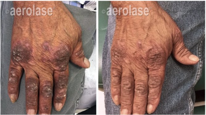 Plaque psoriasis on the hands, 2 treatments before and after with the Aerolase Neo Elite, photo courtesy of Mark Nestor, MD, PhD