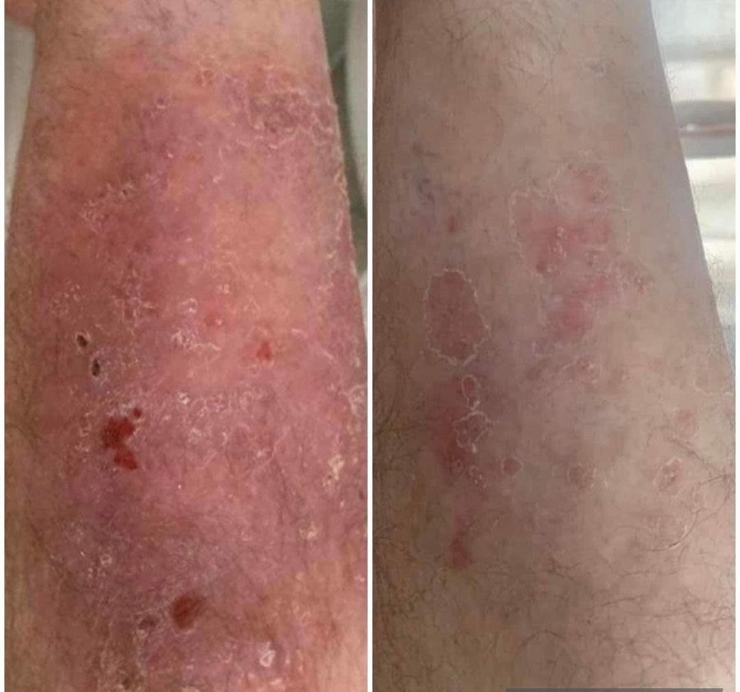 Psoriasis on the leg before and after with the Aerolase Neo Elite, photo courtesy of Sante Second Regard