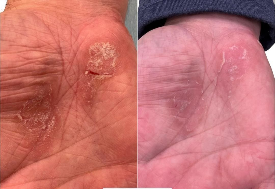 A single psoriasis plaque on the palm before and after with the Aerolase Neo Elite, photo courtesy of Aerolase Corp.