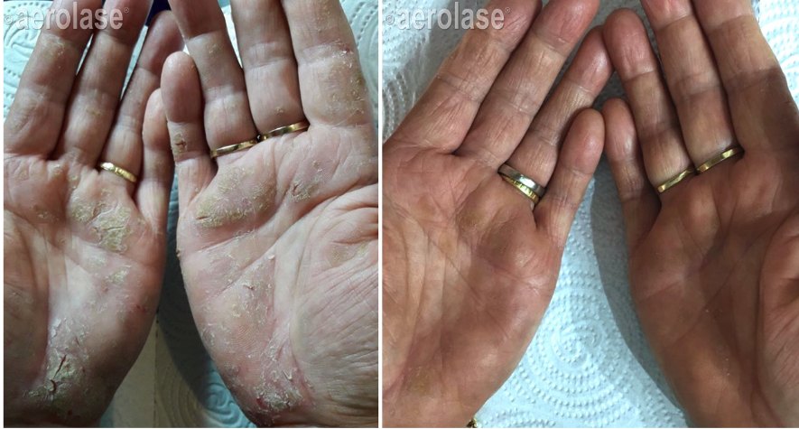 Psoriasis on the palms, 4 treatments and 4 weeks post before and after with the Aerolase Neo Elite, photo courtesy of Aerolase Corp.