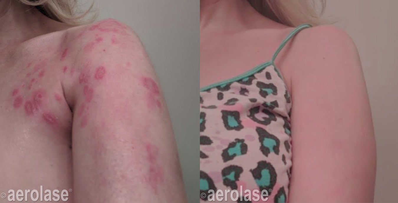 Psoriasis on the shoulder and upper arm, 4 treatments before and after with the Aerolase Neo Elite, photo courtesy of Aerolase Corp.