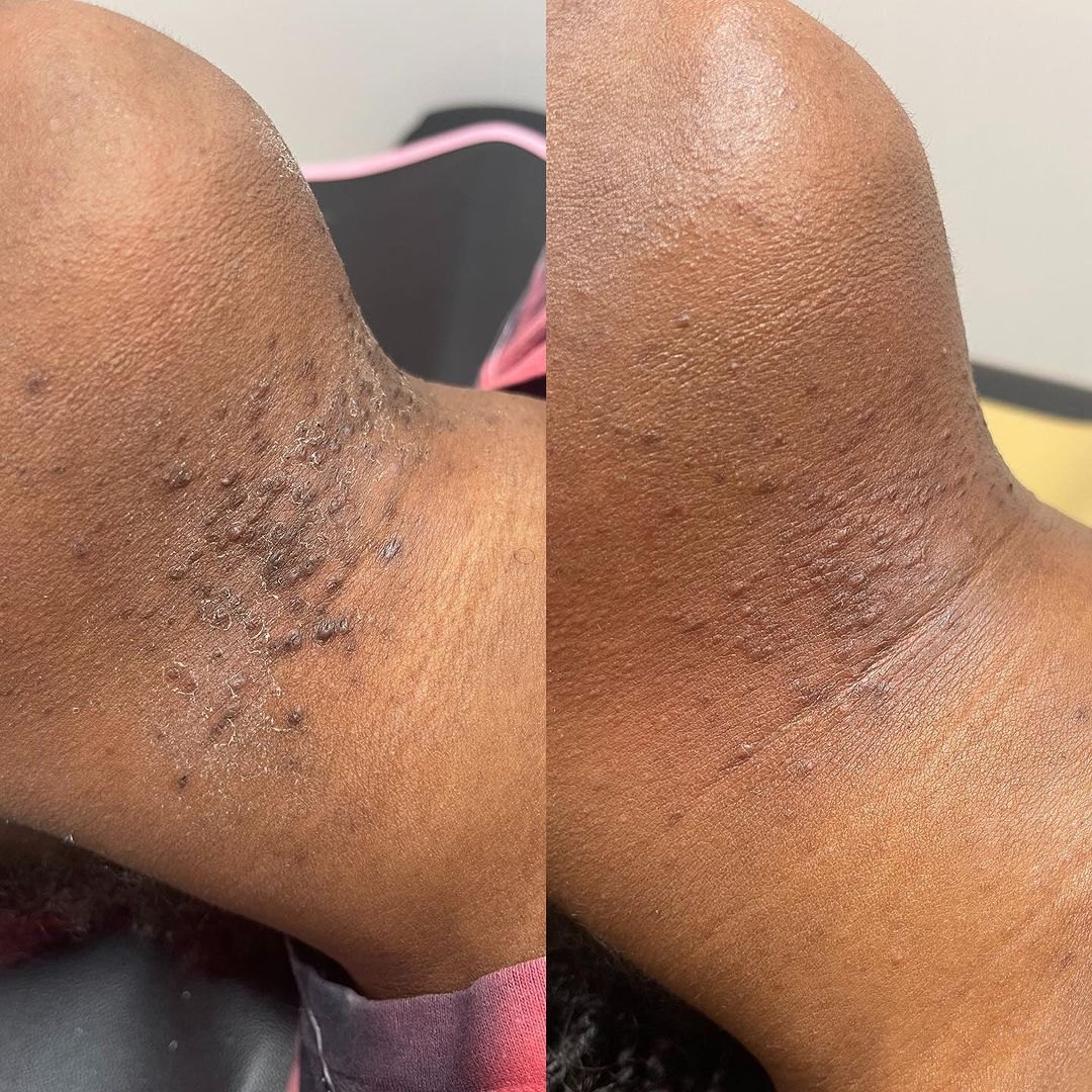 Pseudofolliculitis barbae, razor bumps on the neck before and after with the Aerolase Neo Elite, photo courtesy of Estyserenity