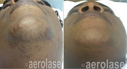 Razor bumps along the jaw and neck before and after with the Aerolase Neo Elite, photo courtesy of Aerolase Corp.