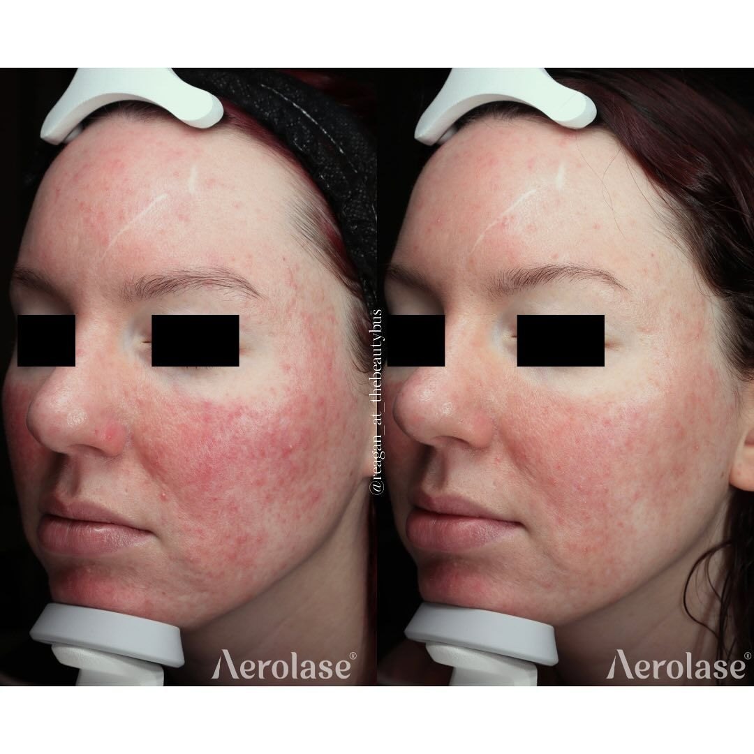 Rosacea, 1 treatment before and after with Aerolase Neo Elite, photo courtesy of The Beauty Bus