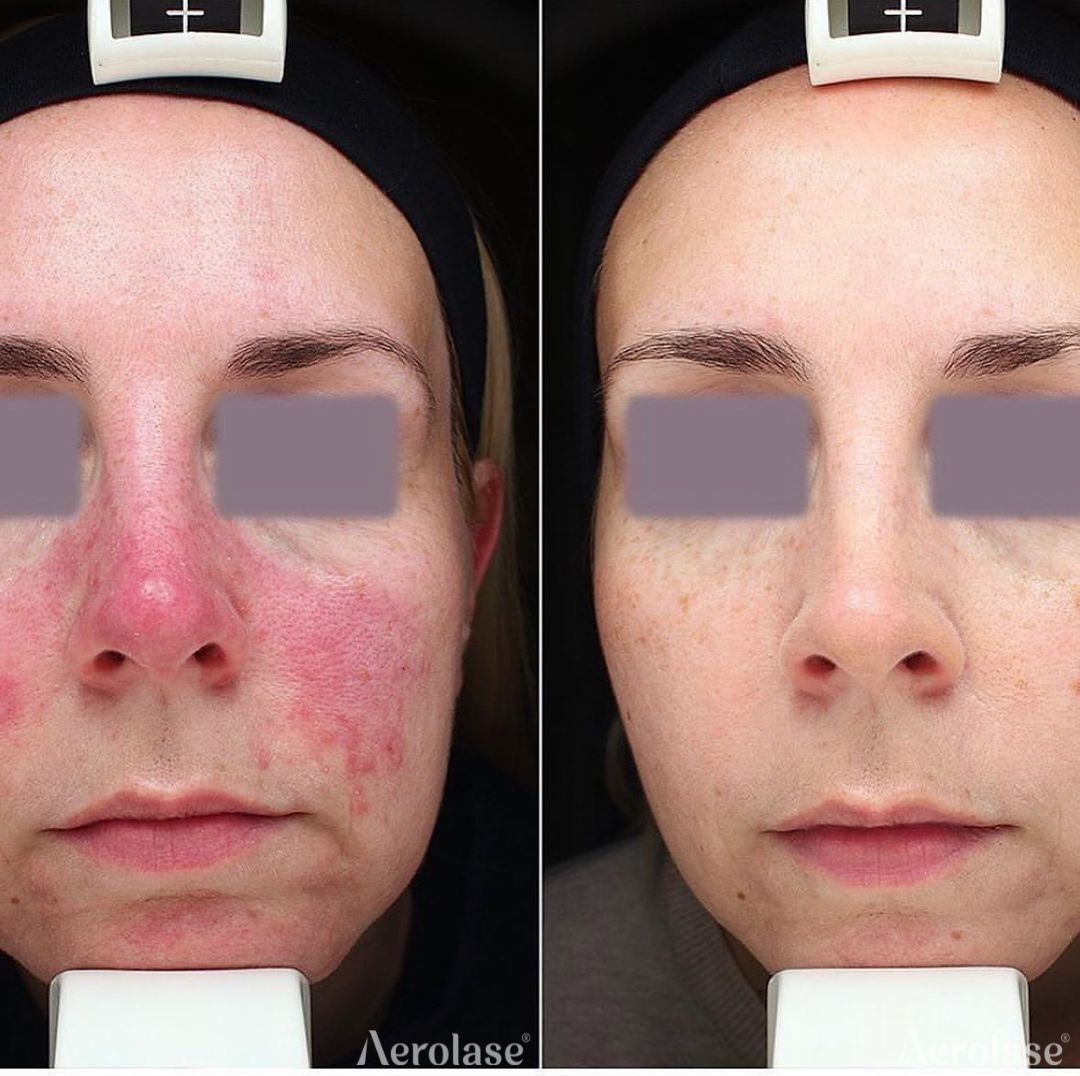 Rosacea and facial redness before and after with Aerolase Neo Elite, photo courtesy of La Derma Beograd