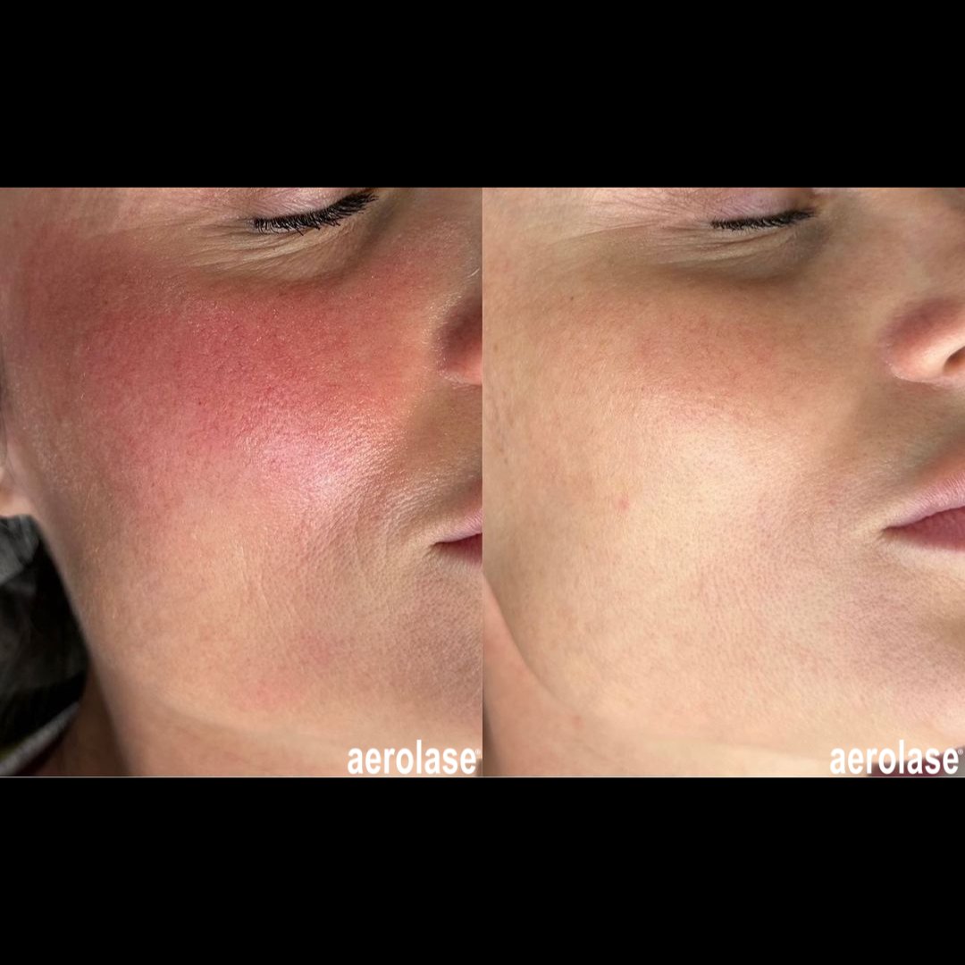 Rosacea across the central face before and after with the Aerolase Neo Elite, photo courtesy of Aerolase Corp.