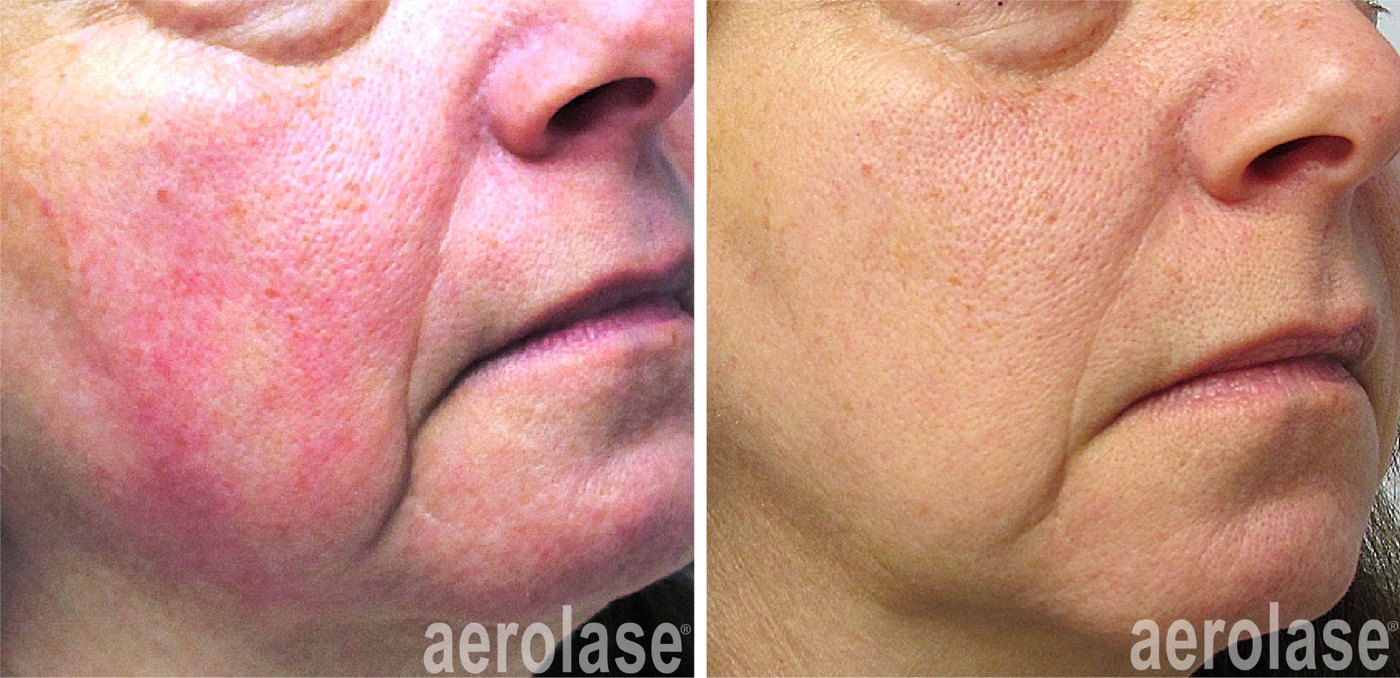 Rosacea on the cheeks, 1 treatment before and after with the Aerolase Neo Elite, photo courtesy of Dr Yelena Kipervas, MD