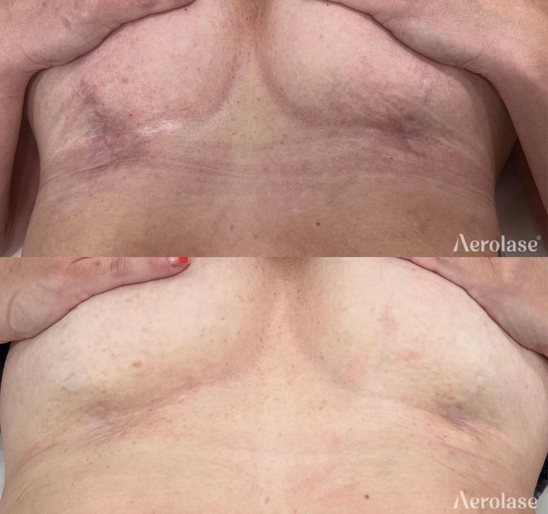 Scarring, 3 treatments before and after with the Aerolase Neo Elite, photo courtesy of Aesthetic NP Kristen