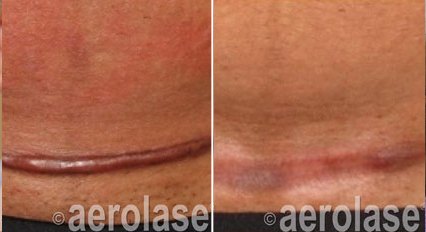 Scar revision before and after with the Aerolase Neo Elite, photo courtesy of Aerolase Corp.