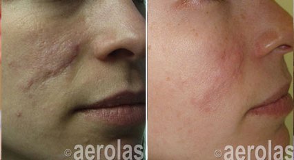 Facial scarring before and after with the Aerolase Neo Elite, photo courtesy of Aerolase Corp.