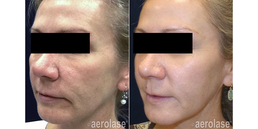Skin rejuvenation, 4 treatments before and after with Aerolase Neo Elite, photo courtesy of Kevin Pinski, MD