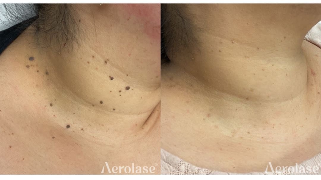 Skin tags on the neck before and after with the Aerolase Neo Elite, photo courtesy of Luminescence Aesthetics