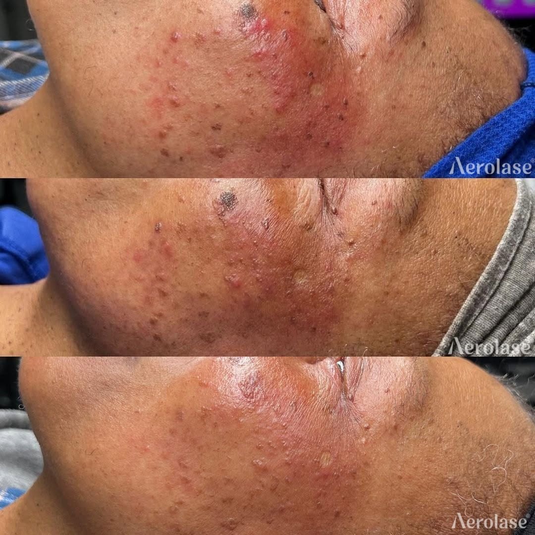 Skin tags with redness and acne, 3 treatments before and after with the Aerolase Neo Elite, photo courtesy of Kim Kreations Co