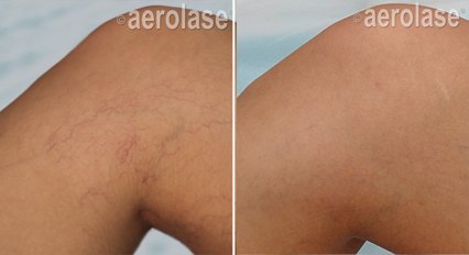 Spider veins before and after with the Aerolase Neo Elite, photo courtesy of Aerolase Corp.