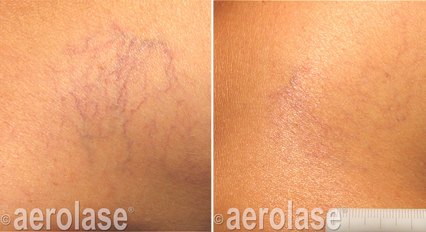 Spider veins on the leg before and after with the Aerolase Neo Elite, photo courtesy of Aerolase Corp.