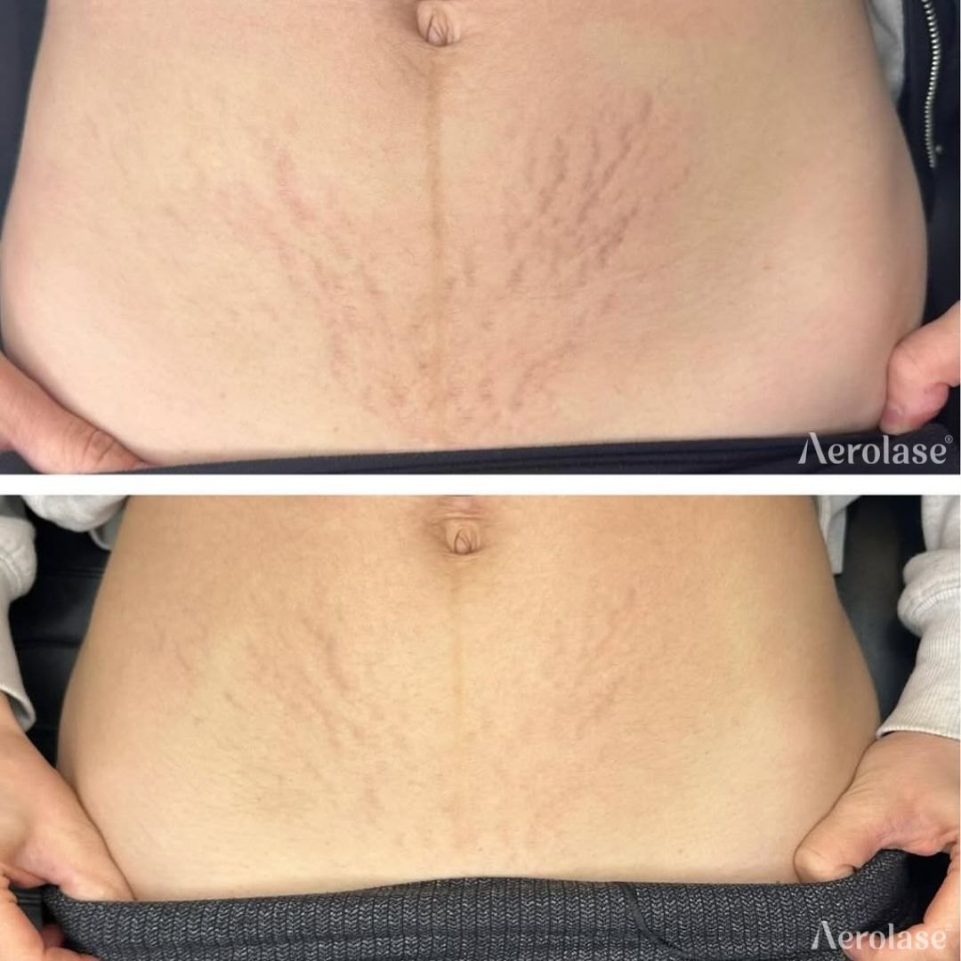 Stretch marks and striae, 4 treatments before and after with the Aerolase Neo Elite, photo courtesy of Luxe PG Esthetics