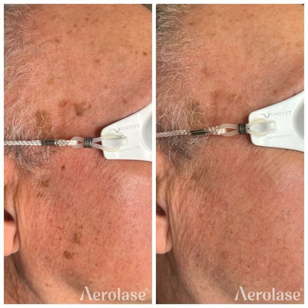 Pigment and sun damage before and after with the Aerolase Neo Elite, photo courtesy of Luxe PG Esthetics