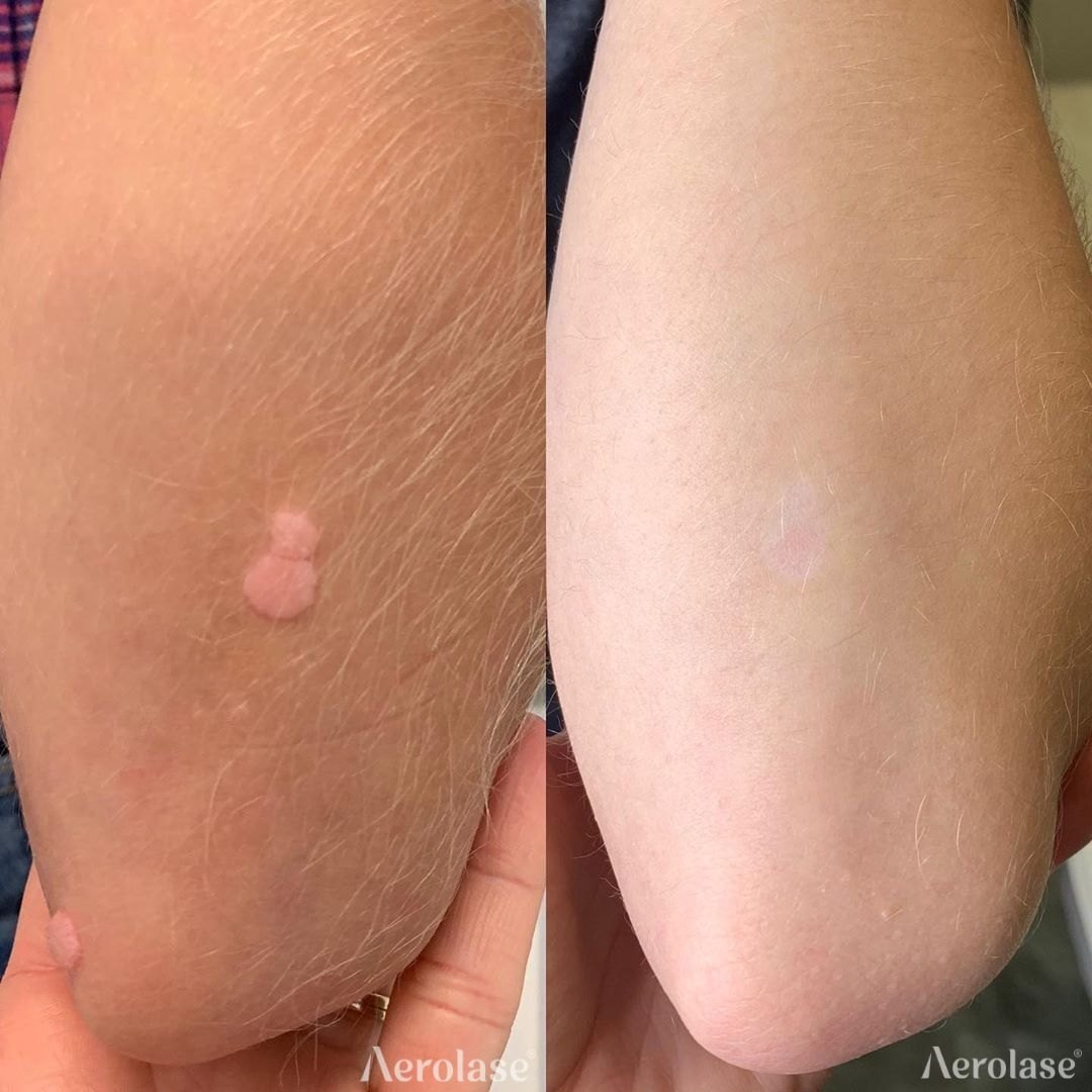 A wart on the arm, 2 treatments before and after with the Aerolase Neo Elite, photo courtesy of Elevate Wellness and Aesthetics