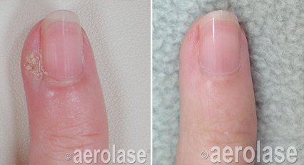 A periungual wart beside the fingernail before and after with the Aerolase Neo Elite, photo courtesy of Aerolase Corp.