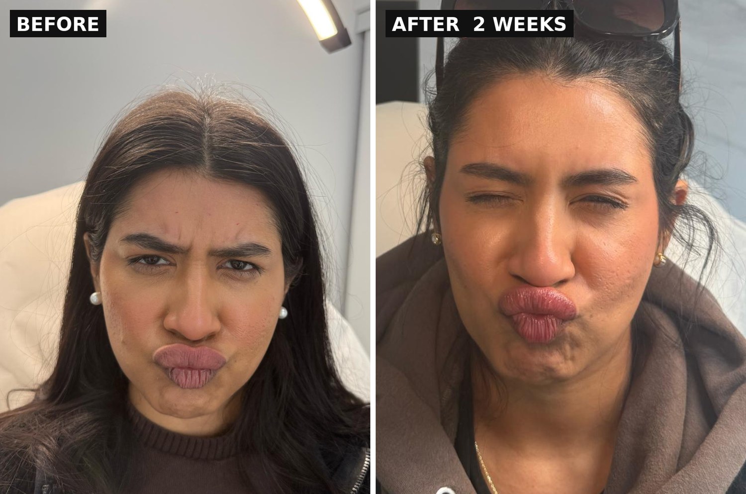Botox before and after for frown lines between the brows, Bar Beauty Medical Toronto