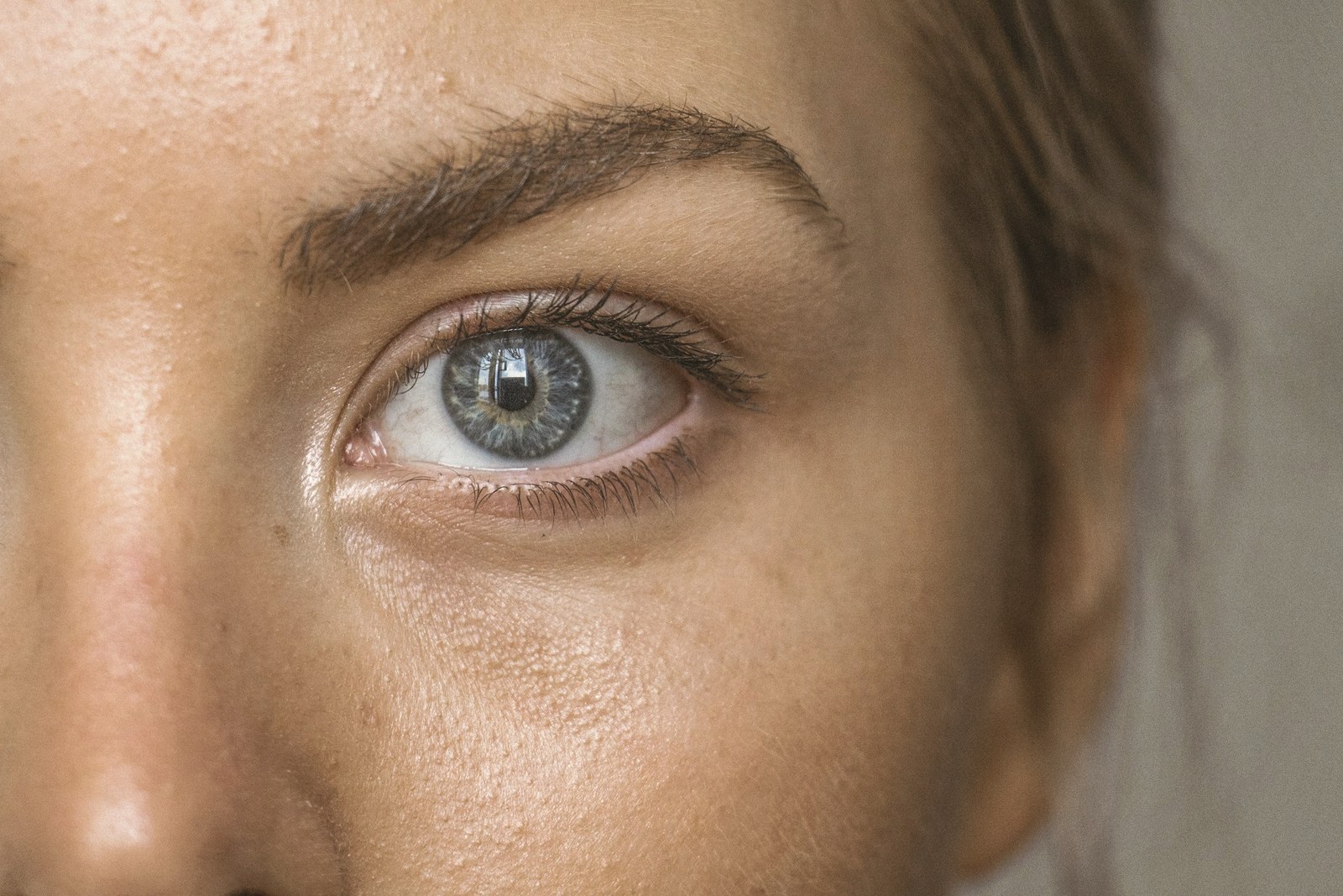 Close up of the under eye and tear trough area where filler migration can show