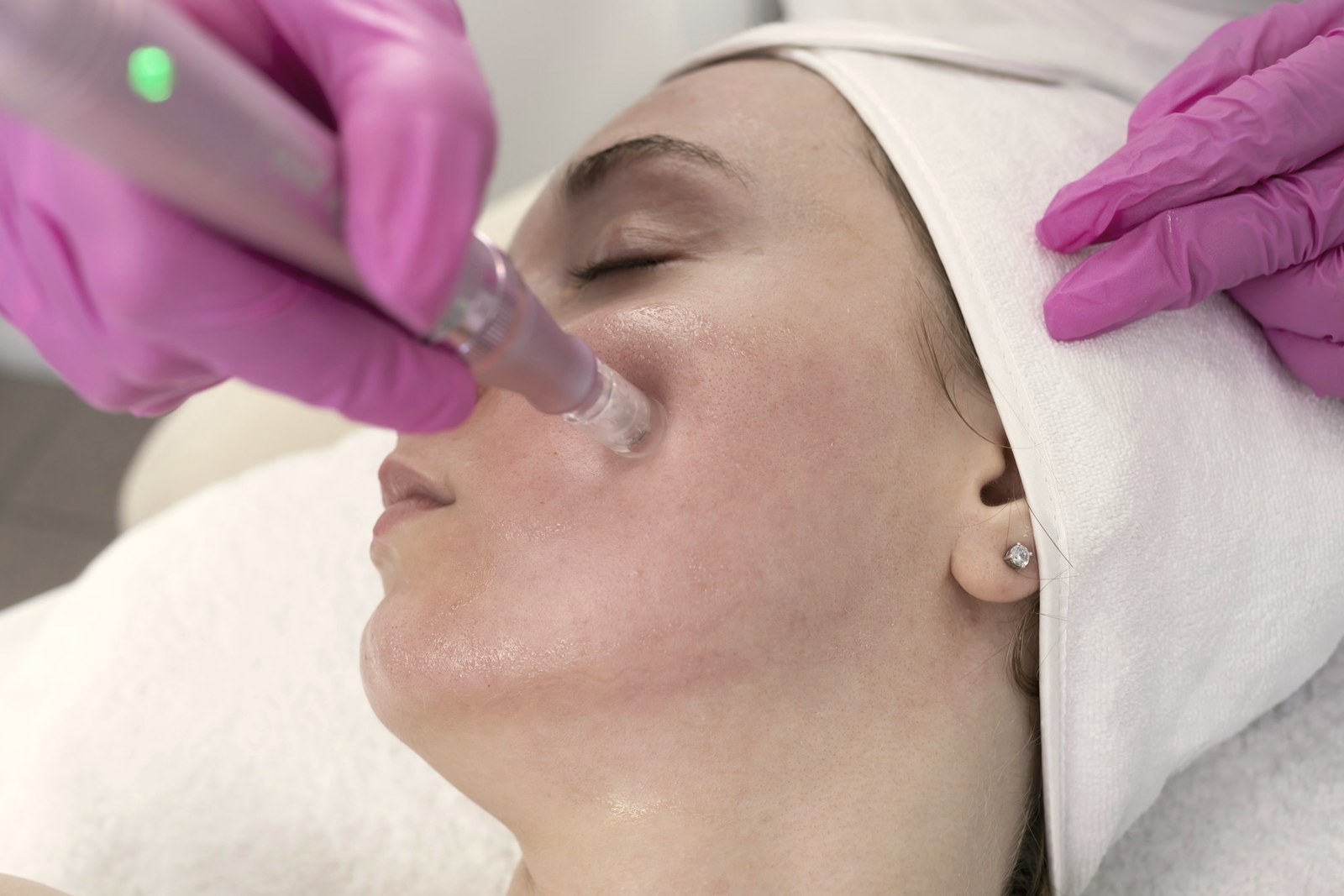 A microneedling pen being used across a patient cheek during treatment