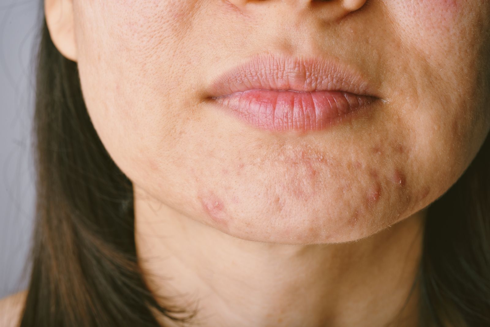 Close-up of adult skin showing both acne breakouts and signs of aging