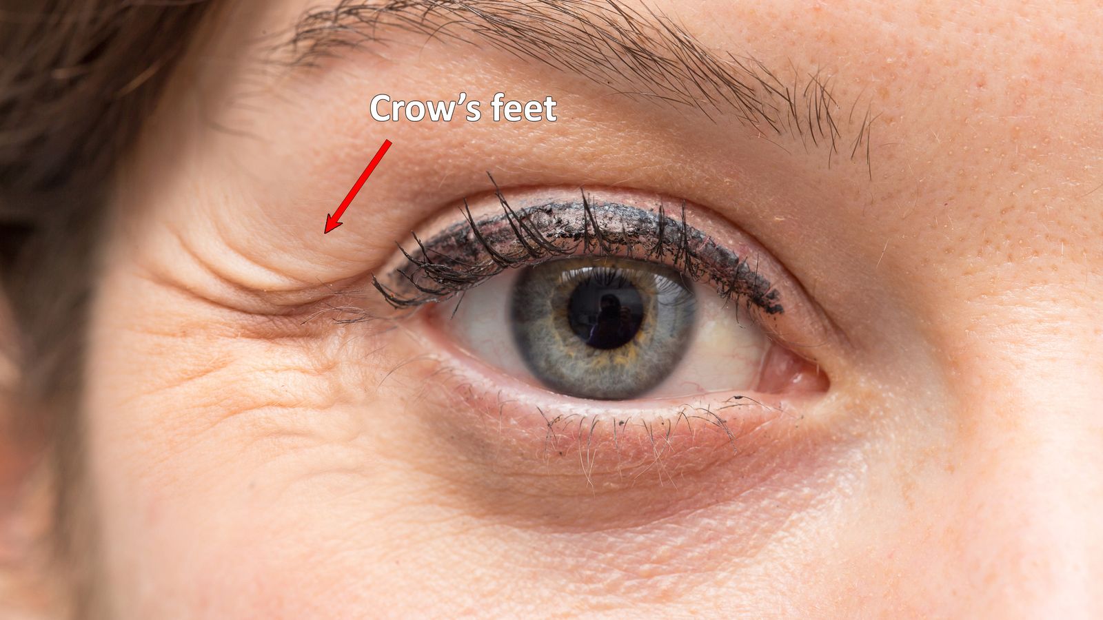 Crows feet wrinkles close-up - Botox vs Fillers - Bar Beauty Medical Toronto