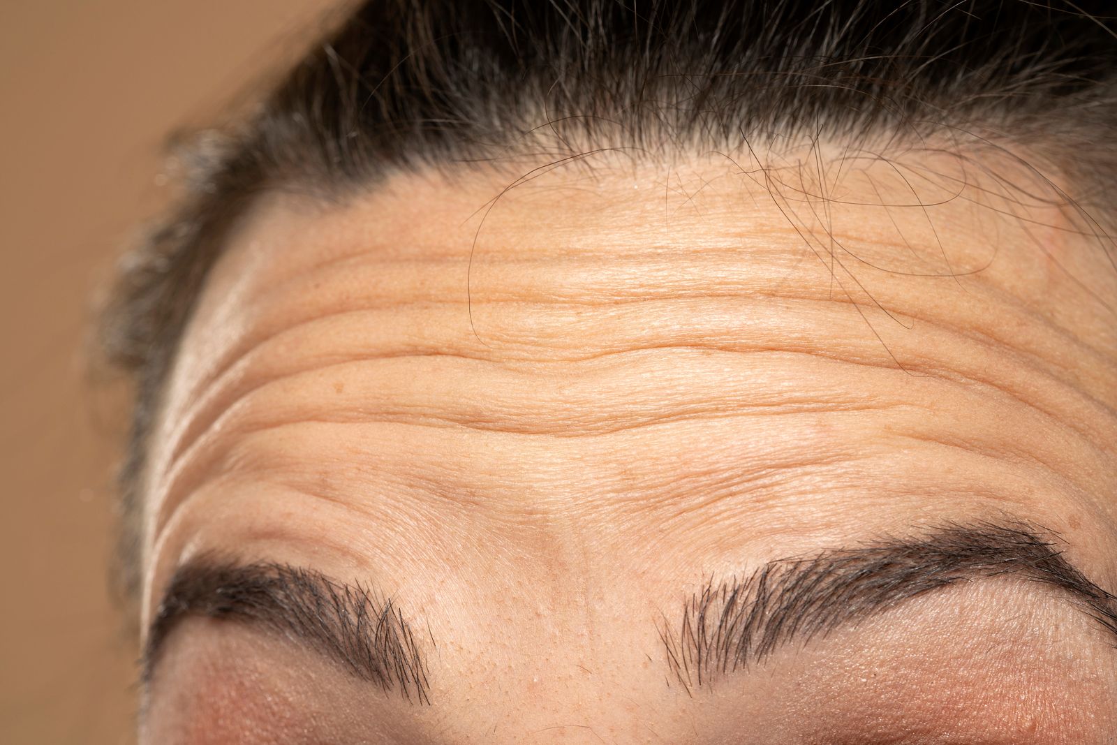 Forehead frown lines wrinkles - Bar Beauty Medical Toronto