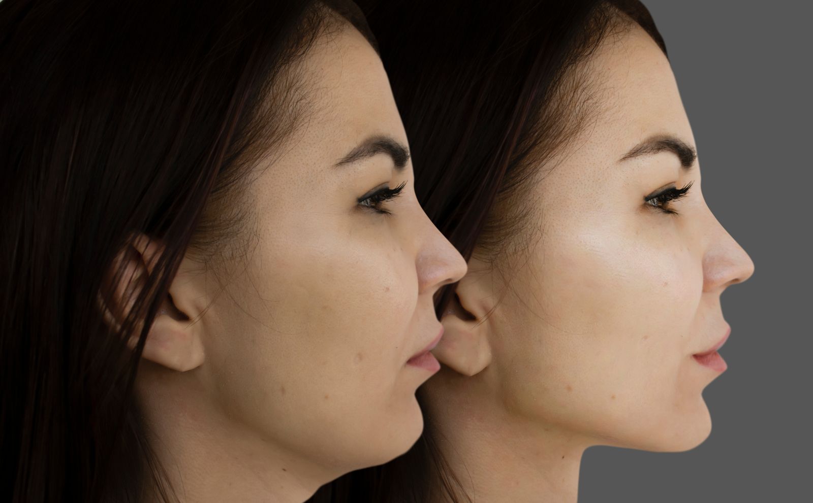 Jawline filler before and after - Bar Beauty Medical Toronto