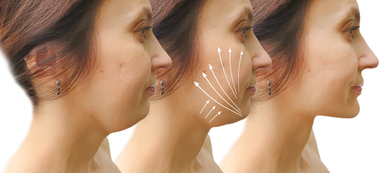 Kybella double chin treatment before and after - Bar Beauty Toronto