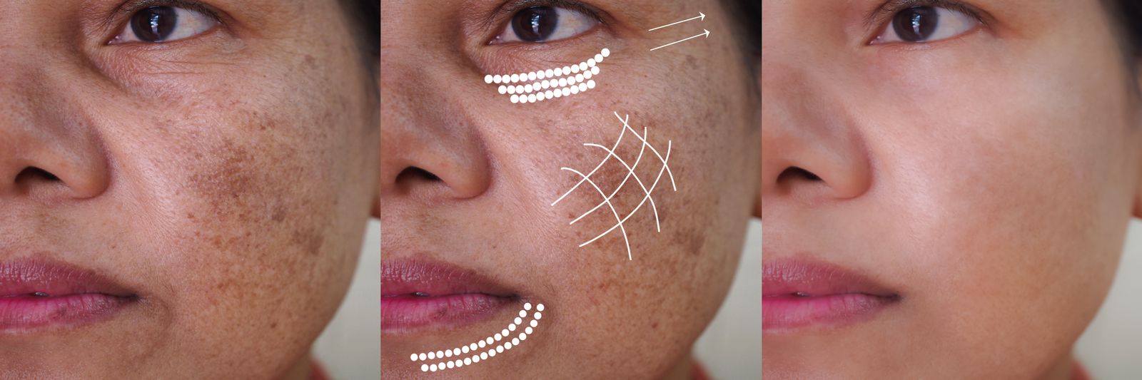 Melasma treatment options at Bar Beauty Medical, Toronto