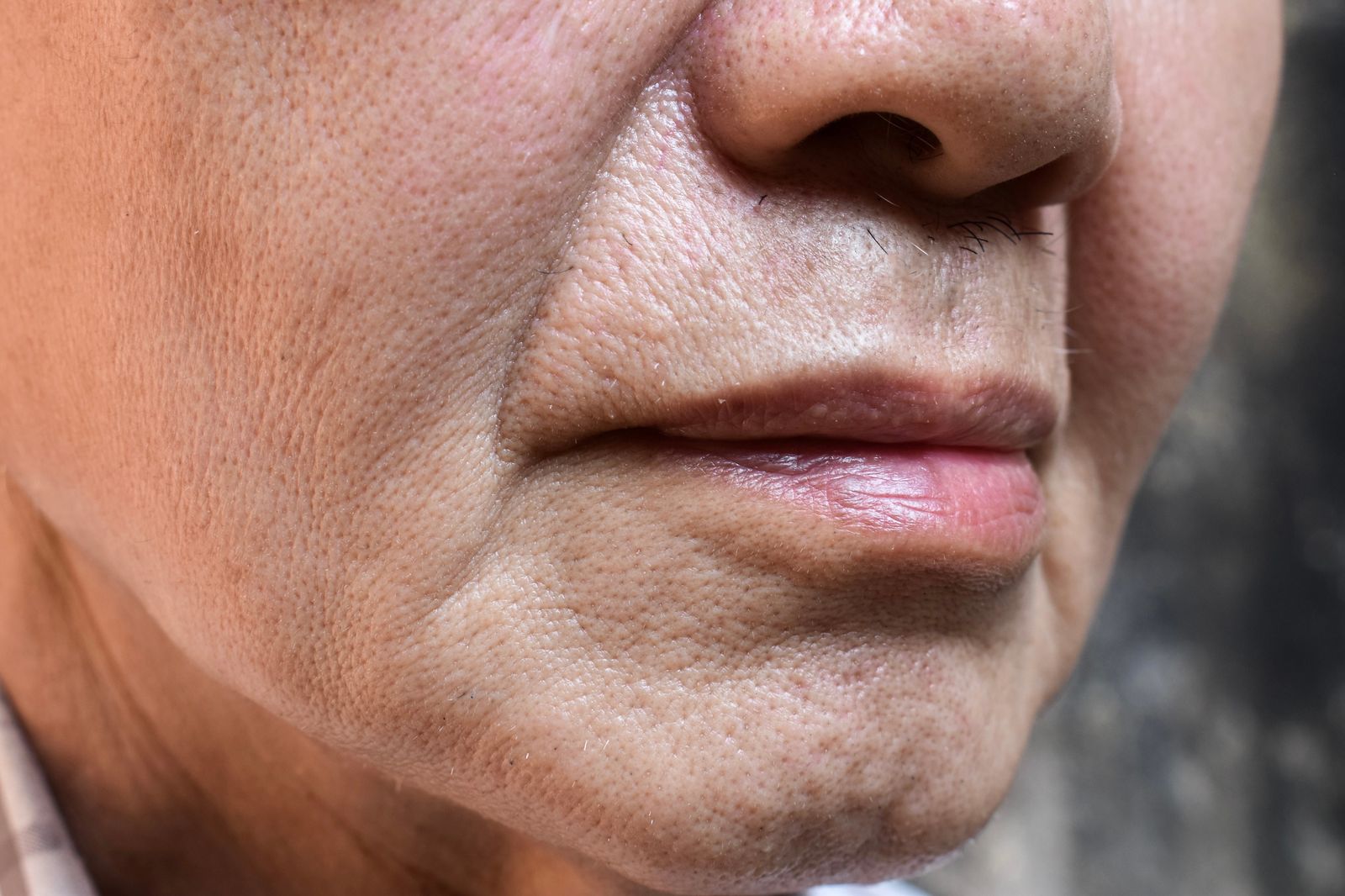 Nasolabial folds and enlarged pores skin treatment - Bar Beauty Medical Toronto