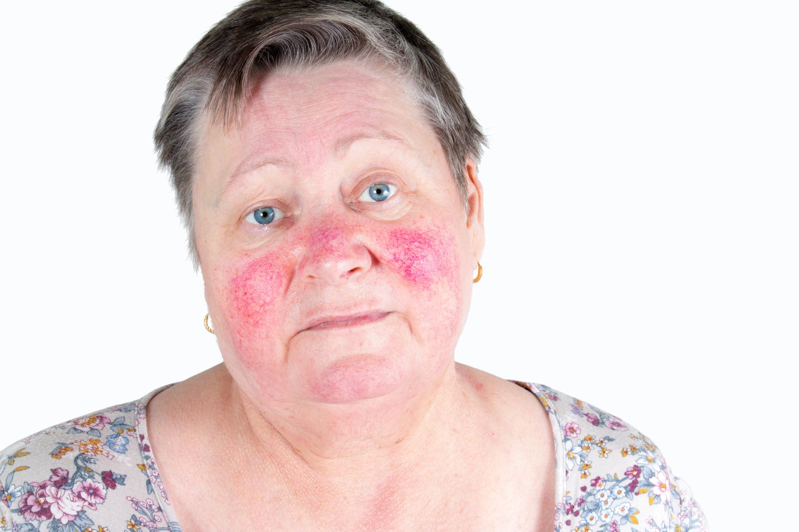 Rosacea facial skin disorder - Bar Beauty Medical Toronto
