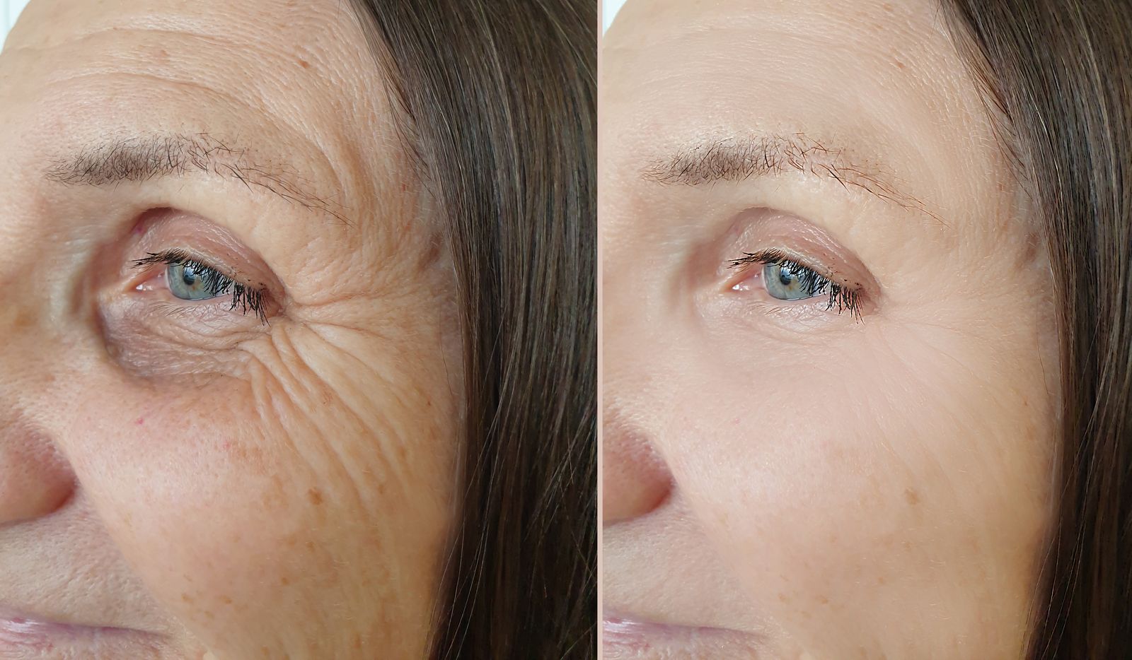 Does Morpheus8 Hurt? Toronto Pain Level + What to Expect, Bar Beauty Medical, Toronto