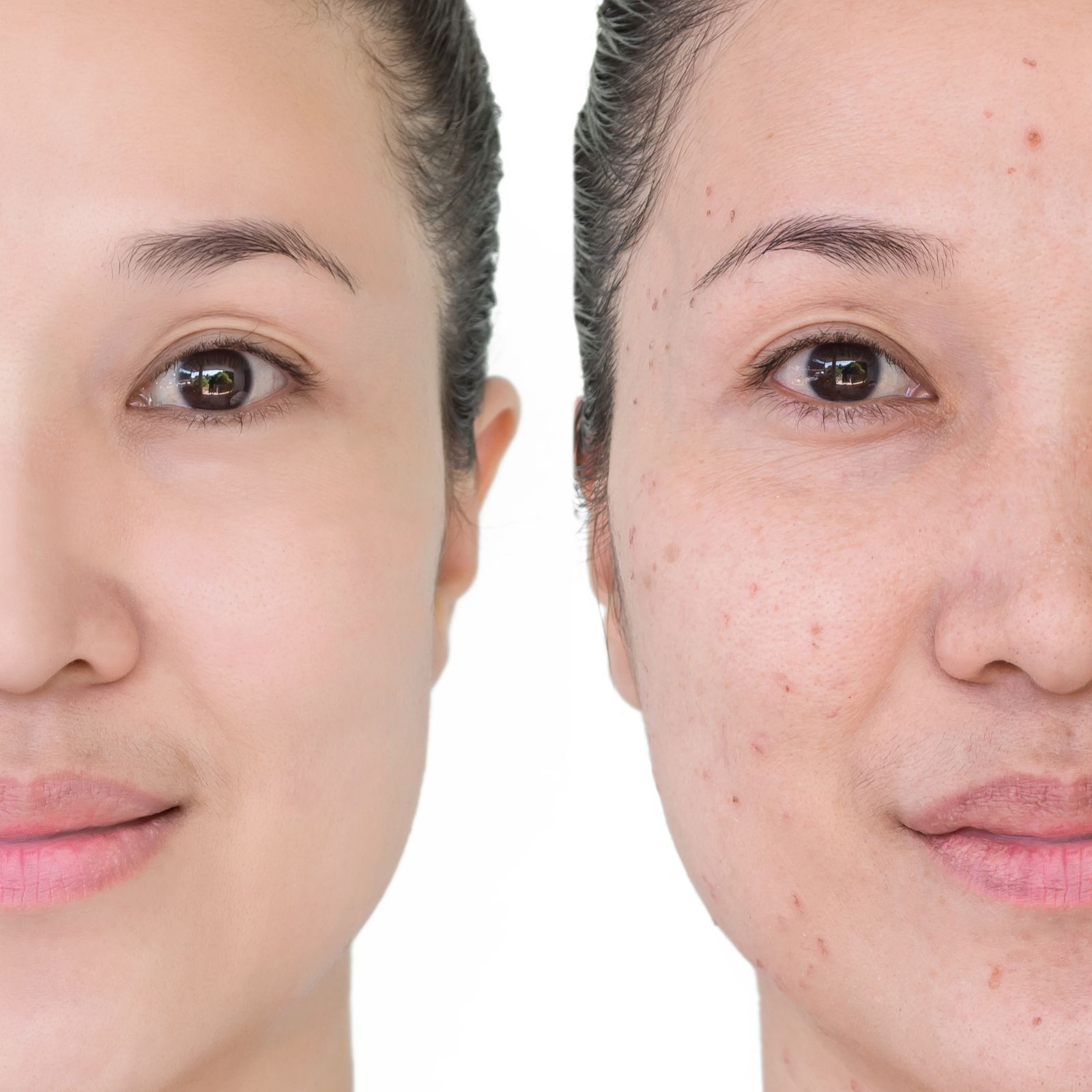 Post-acne treatment roadmap in Toronto at Bar Beauty Medical, CityPlace clinic