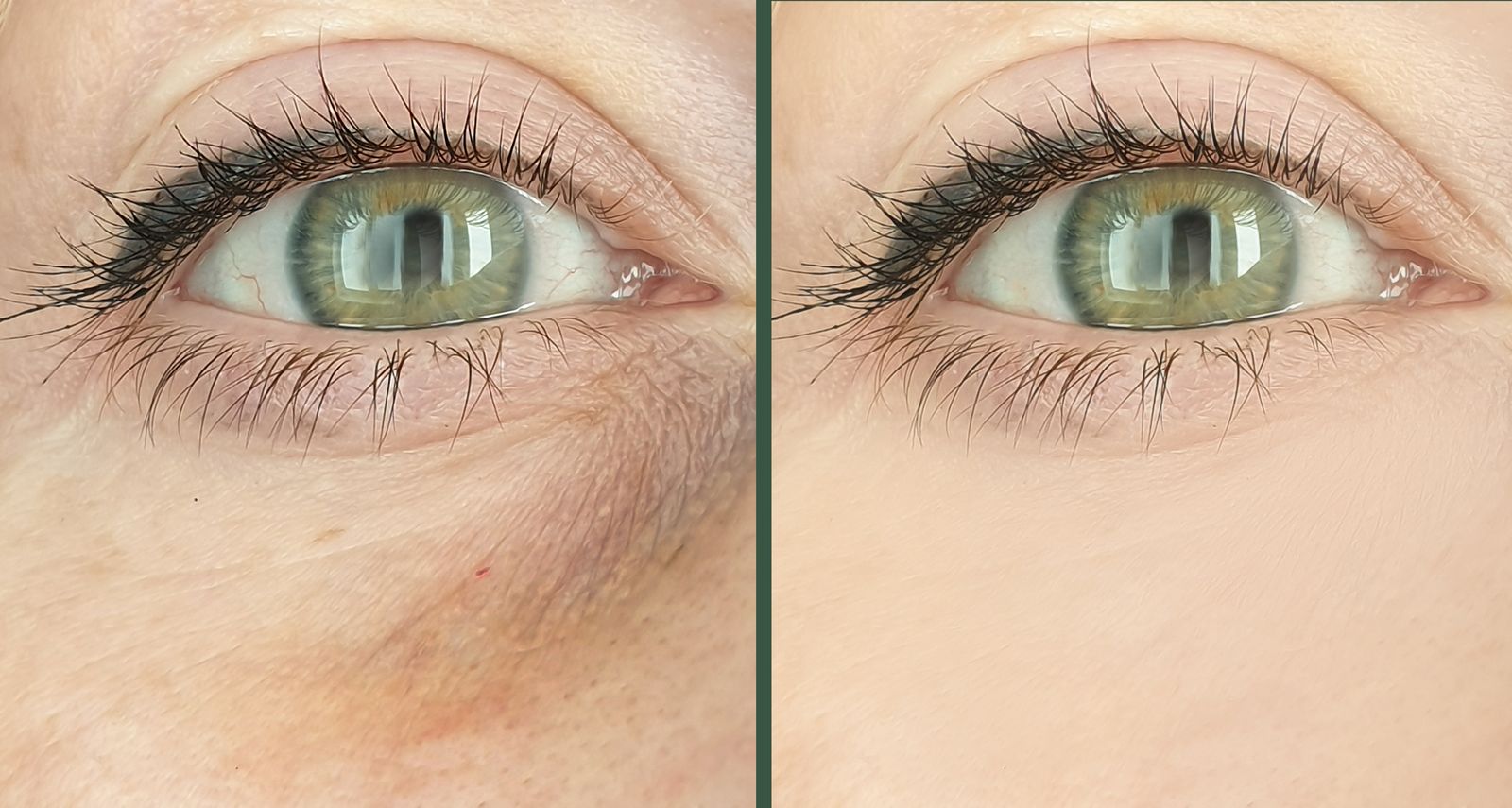 Under eye bag and tear trough treatment at Bar Beauty Medical, CityPlace Toronto