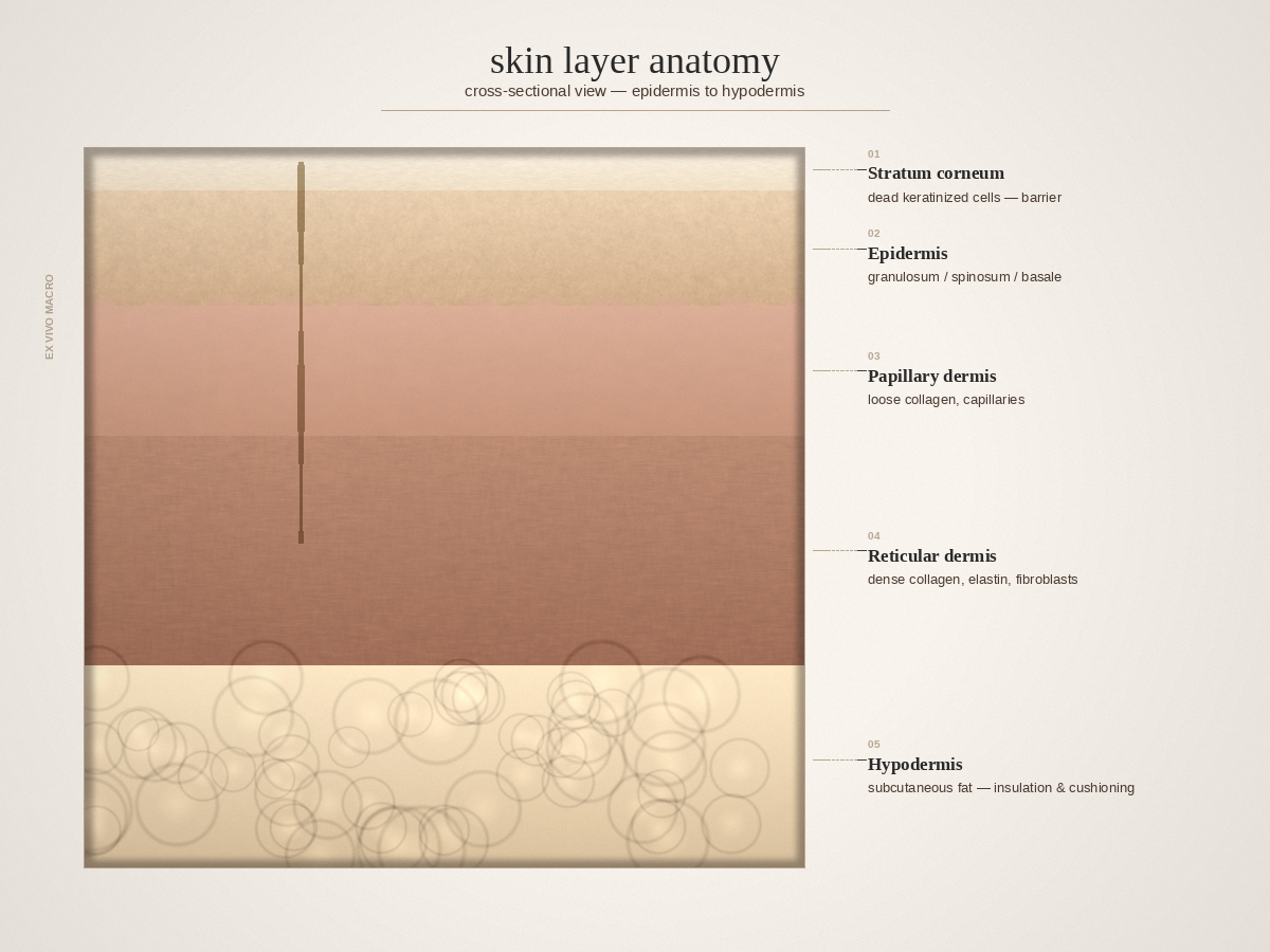 Skin layers cross-section: epidermis, dermis, and hypodermis with treatment-depth annotations